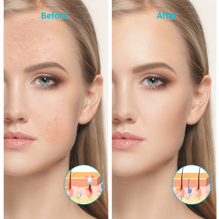 XPREEN XPRE052 Dispositivo per il trattamento dell'acne leggero ricaricabile wireless Gomma per eliminare l'acne domestica con luce blu e luce rossa, XPRE052